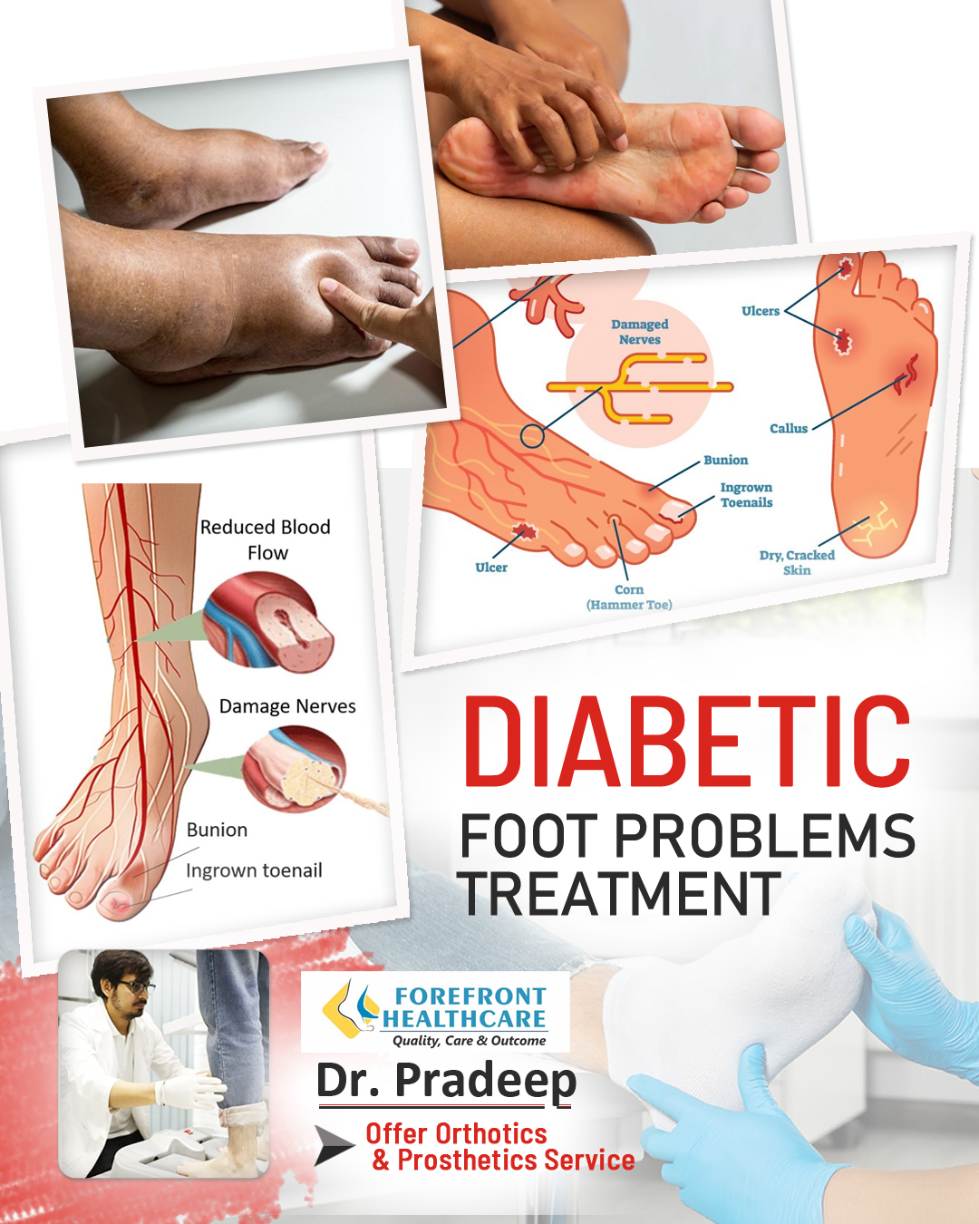Can Diabeties Create Foot Pain ?