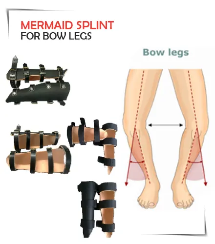 Mermaid Splint kaushambi Ghaziabad