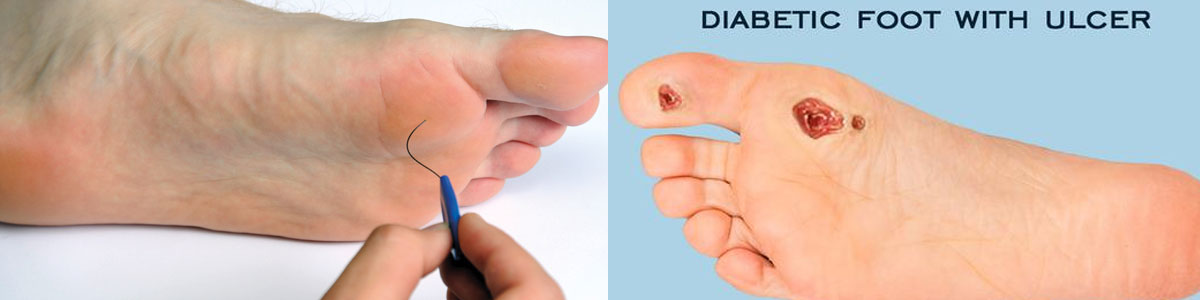 Diabetic Foot