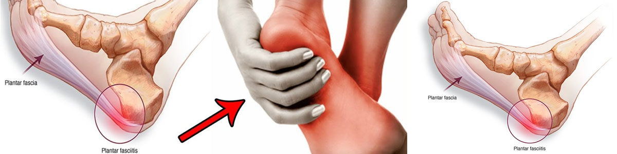 Plantar Fasciitis insoles